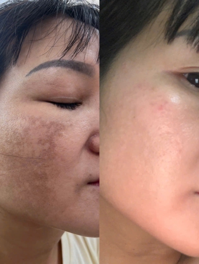 Điều trị nám an toàn và hiệu quả