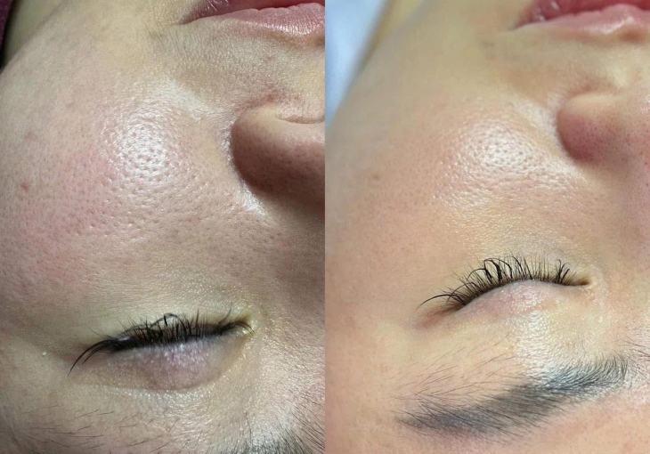 Căng bóng trắng sáng mịn màng bình chánh