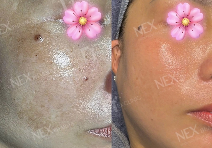Công nghệ mới điều trị nám bình chánh