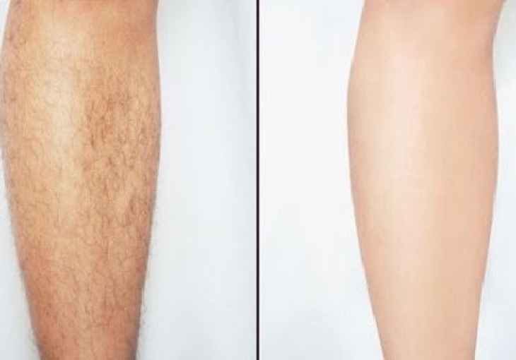 Triệt Lông Vĩnh Viễn