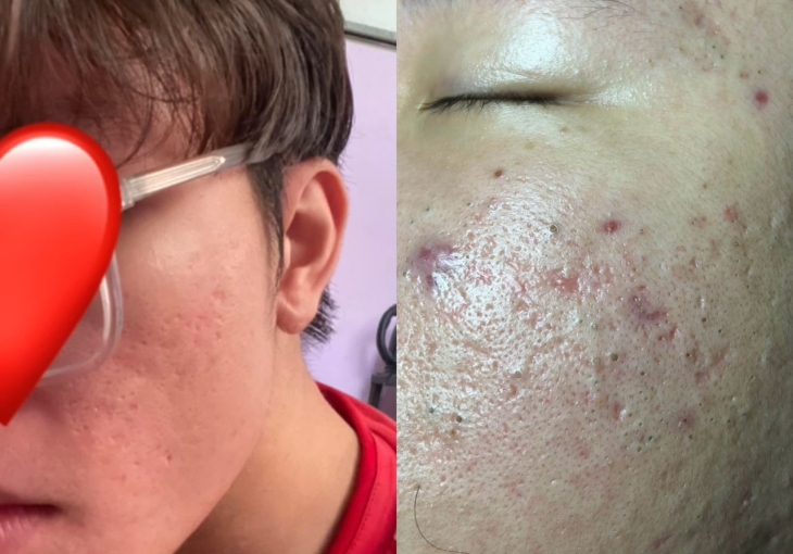 Spa Xử lý Mụn Uy Tín Tại Bình Chánh