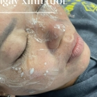 Đốt Tàn Nhan, Mụn Thịt, Nốt Ruồi