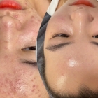 Xử lý mụn uy tín hiệu quả bình Chánh