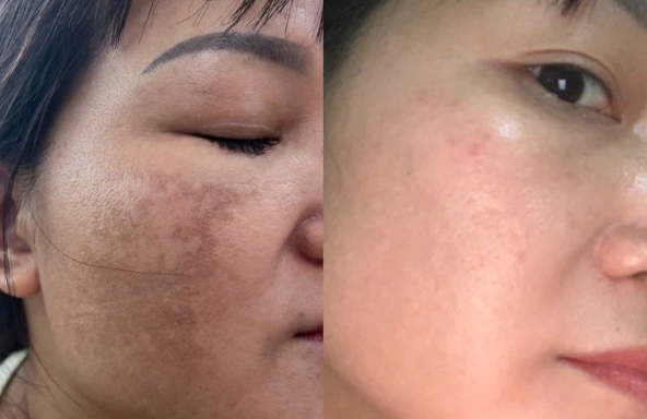 Điều trị nám an toàn và hiệu quả